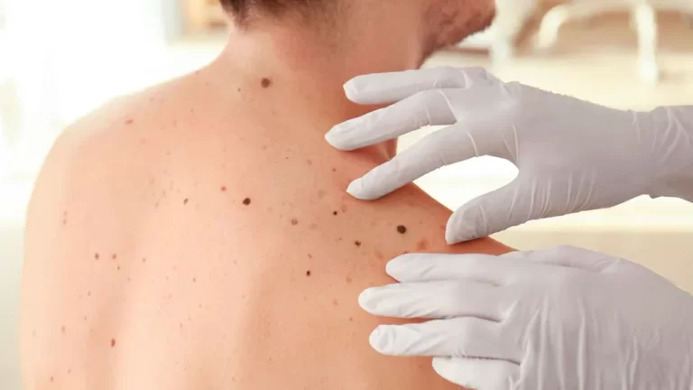Chequeos gratuitos en la Costa para prevenir el cáncer de piel